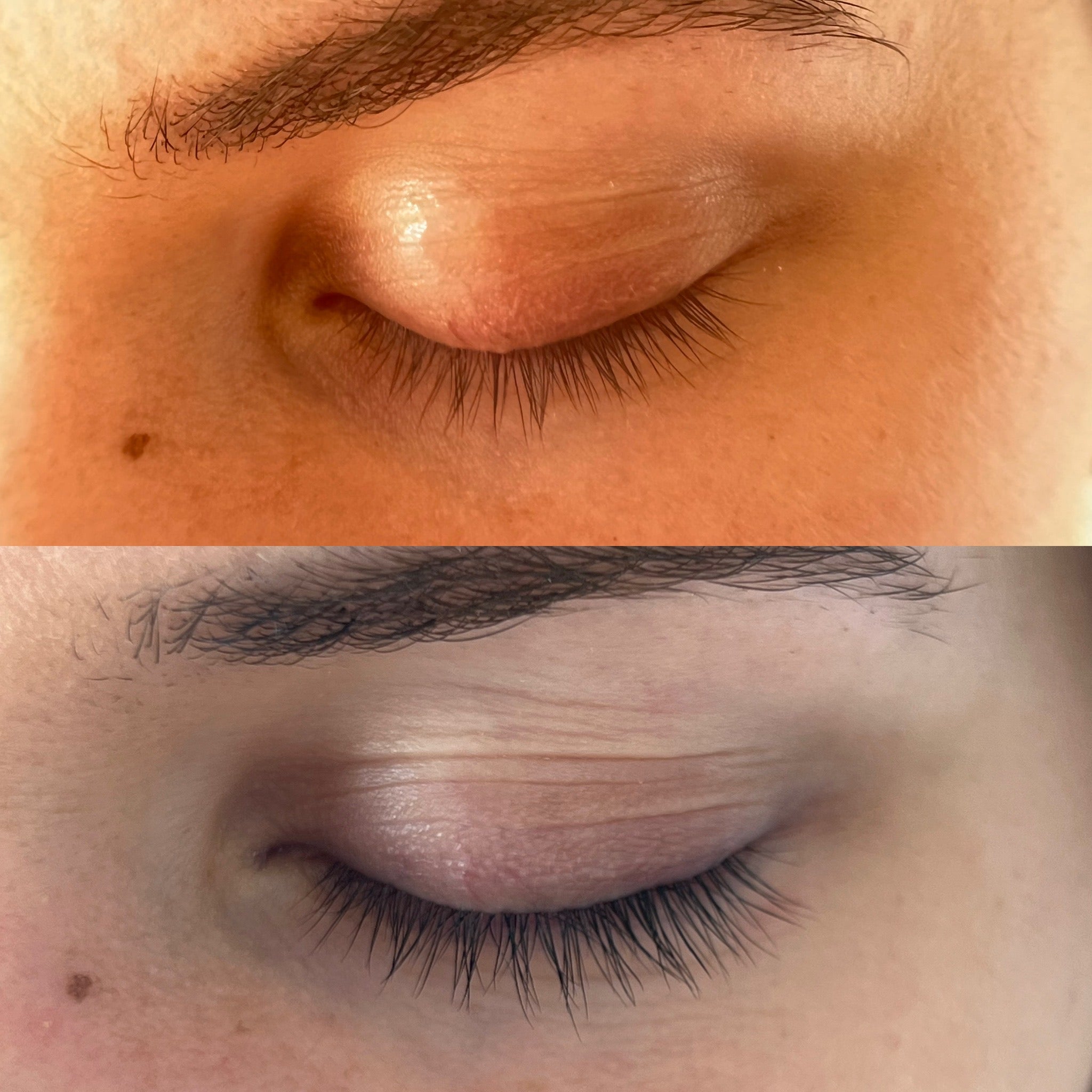 Before and after comparison of a person's eye area with and without a treatment.